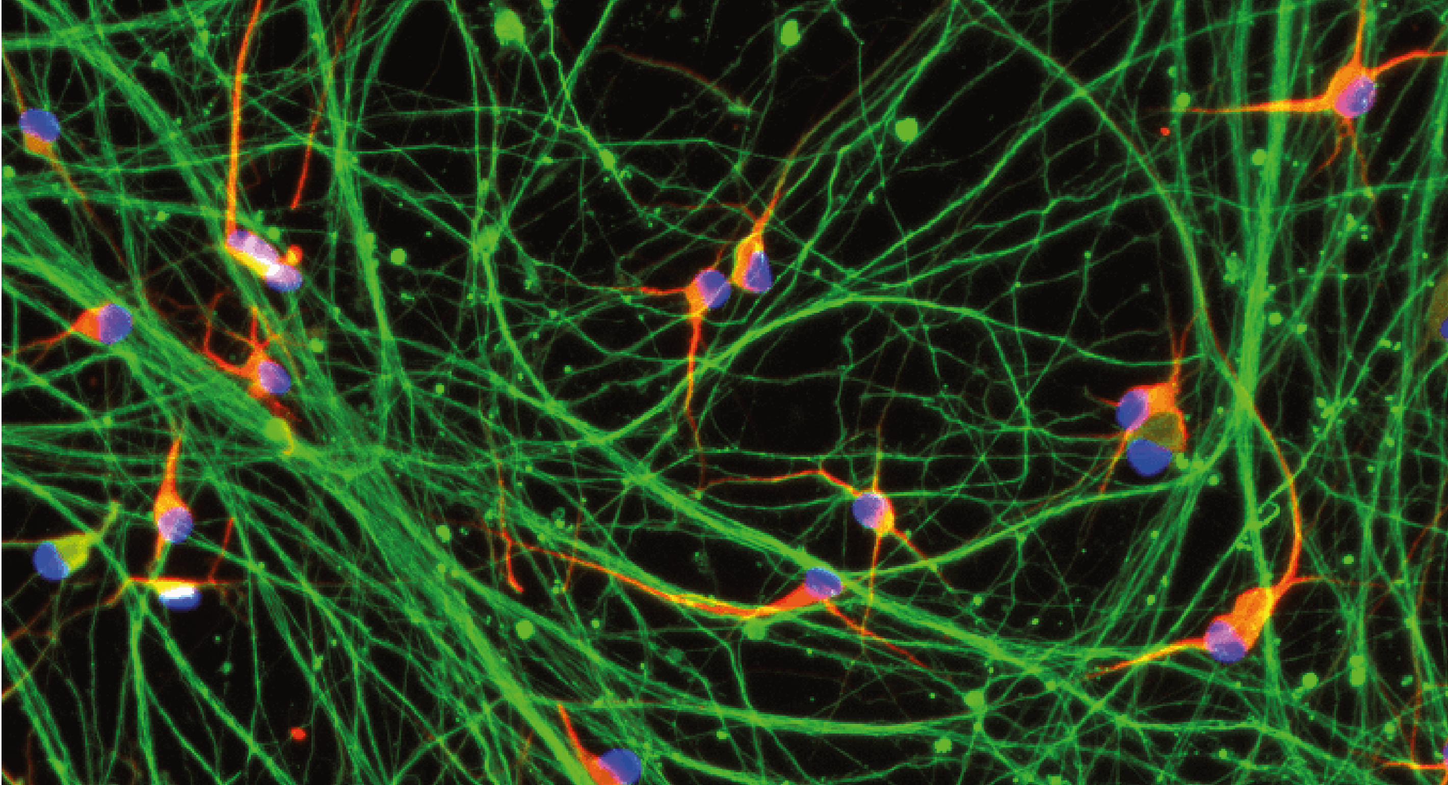 An ICC image depicting iPSC-derived glutamatergic neurons containing a disease inducing mutation